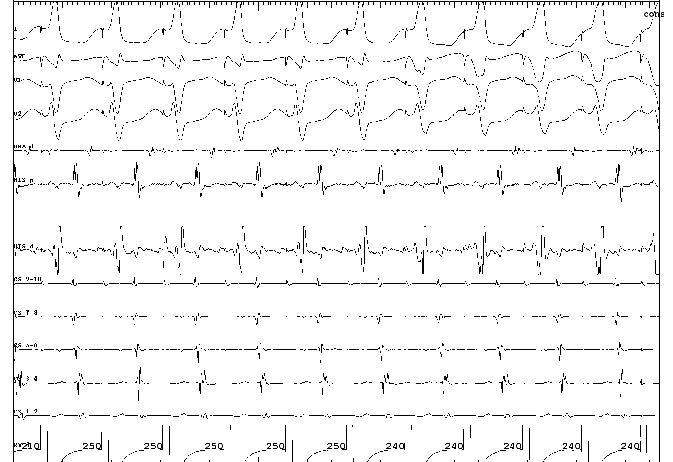 02_constant and progressive fusion.JPG